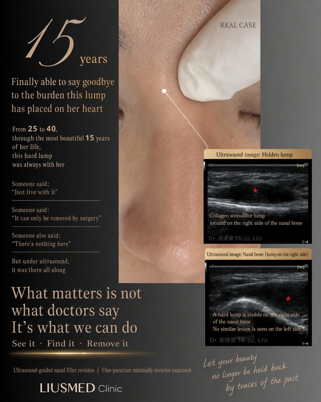A 15-Year Burden: Ultrasound-Guided Nasal Filler Revision Finally Brings Relief