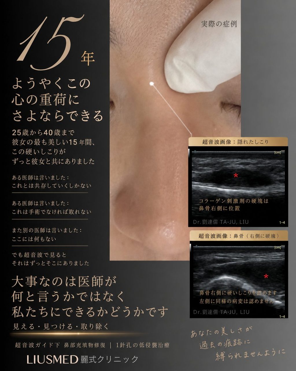 15年間の心のしこり：超音波ガイド下鼻部フィラー修復でついに解放
