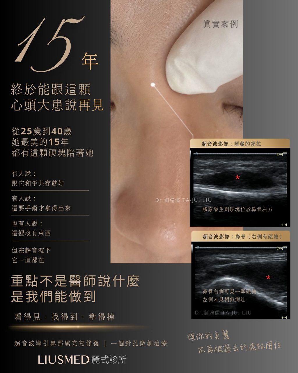 15年的心結，超音波導引鼻部填充物修復讓她終於放下