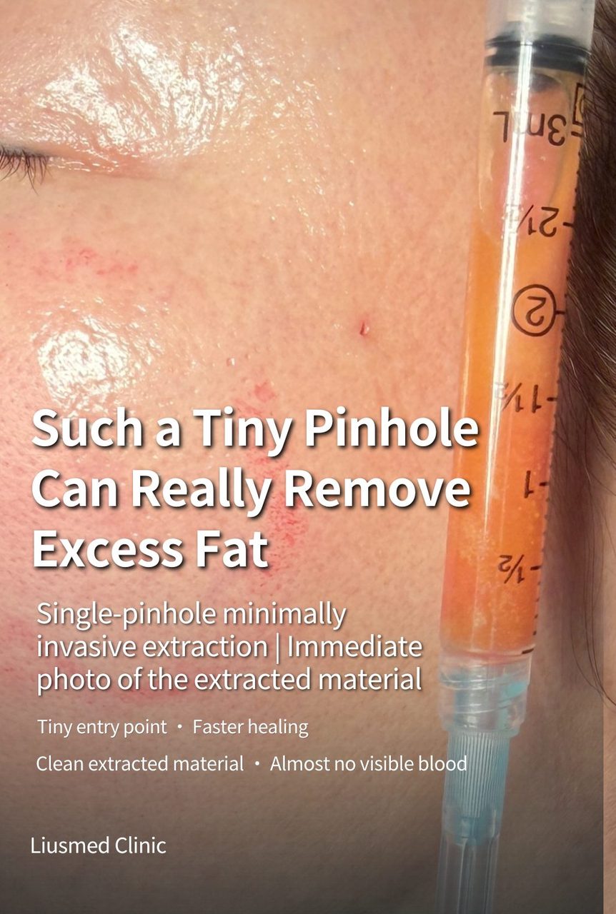 Facial Autologous Fat Overfilling: Minimally Invasive Pinhole Extraction to Correct 'Overfilled' Apple Cheeks