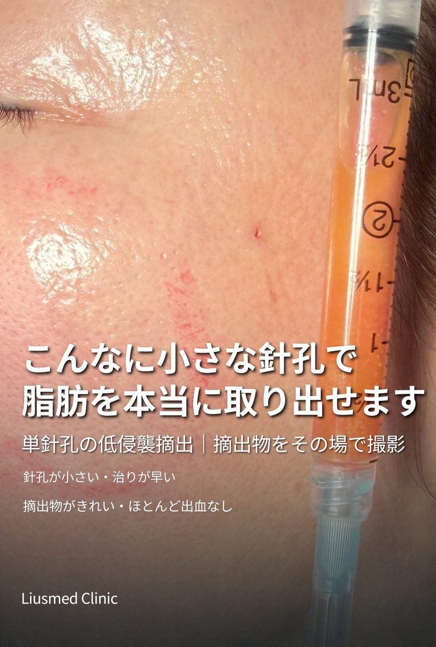 顔の自家脂肪過剰注入：単一針穴からの低侵襲除去で「饅頭化（Overfilled）」したアップルゾーンを改善