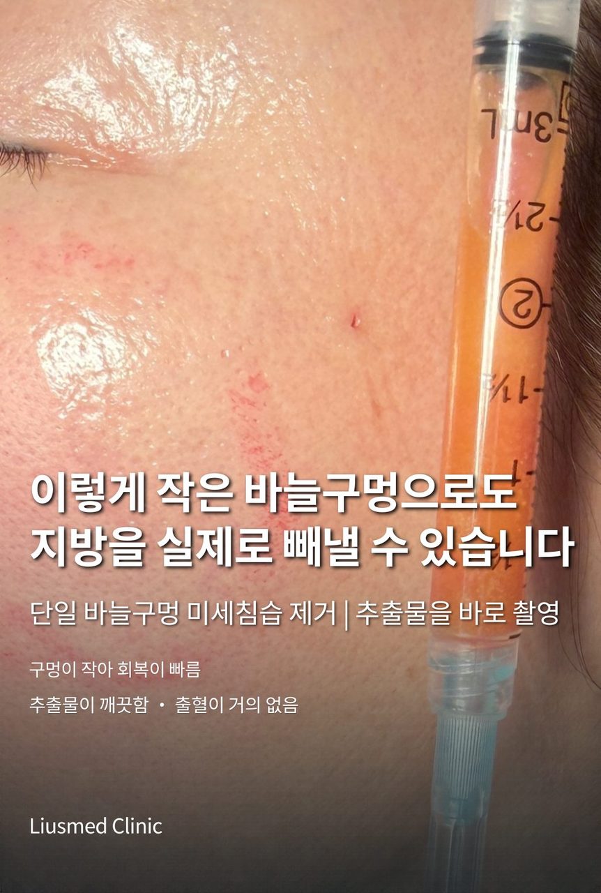 얼굴 자가지방 과다 주입: 단일 핀홀 최소 침습 제거로 '만두얼굴' 작별하기