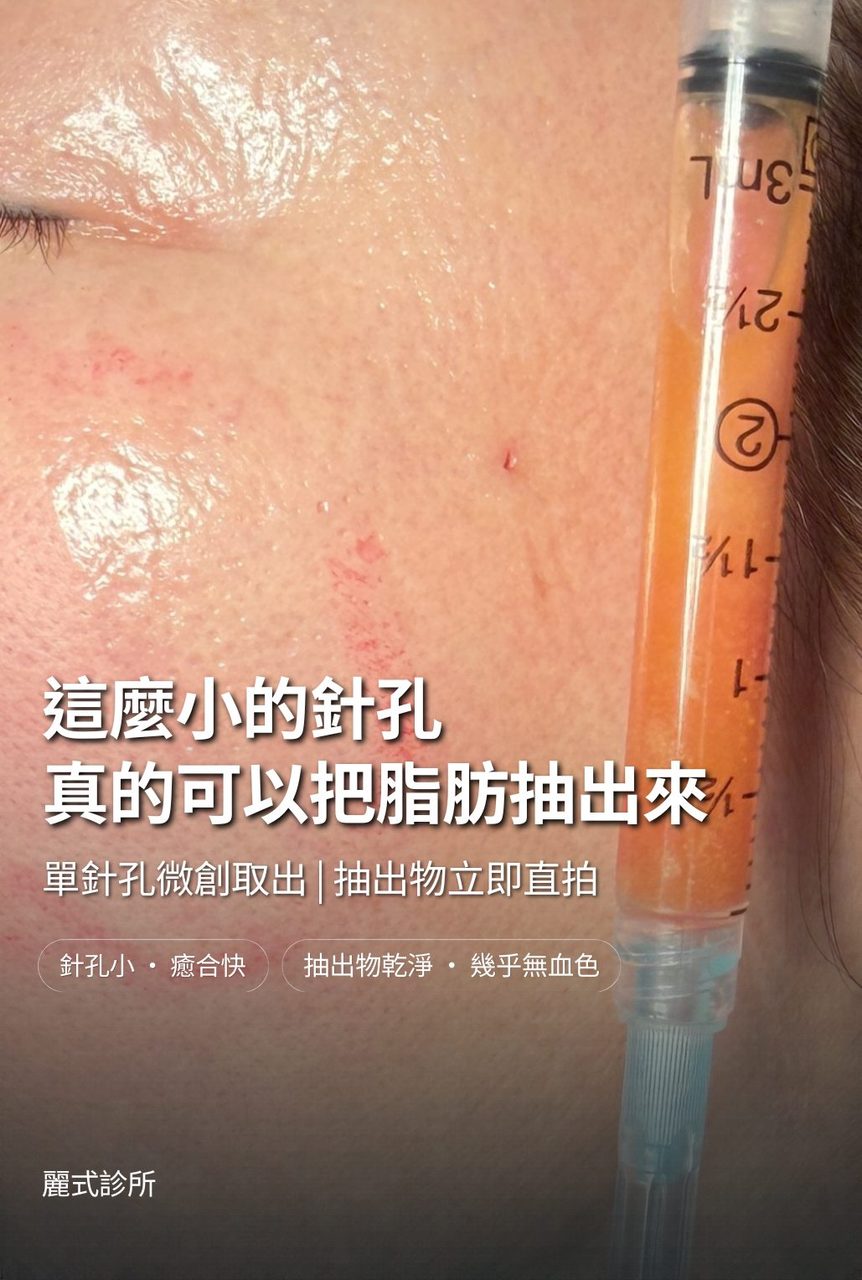 臉部自體脂肪過度填充：單針孔微創取出，告別「饅化」蘋果肌