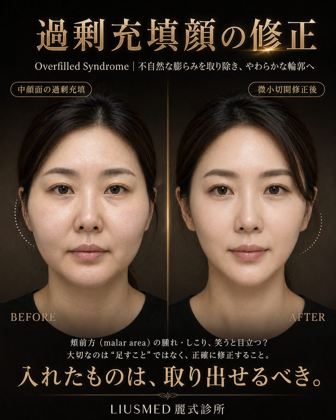 笑顔をためらう「饅頭化」の悩み：エランセによるしこりの低侵襲修復