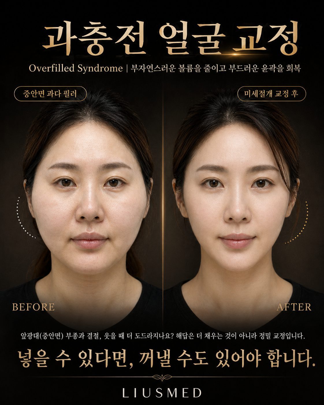 웃음을 주저하게 만드는 '만두얼굴' 고민: 엘란세 경결의 최소 침습 수복