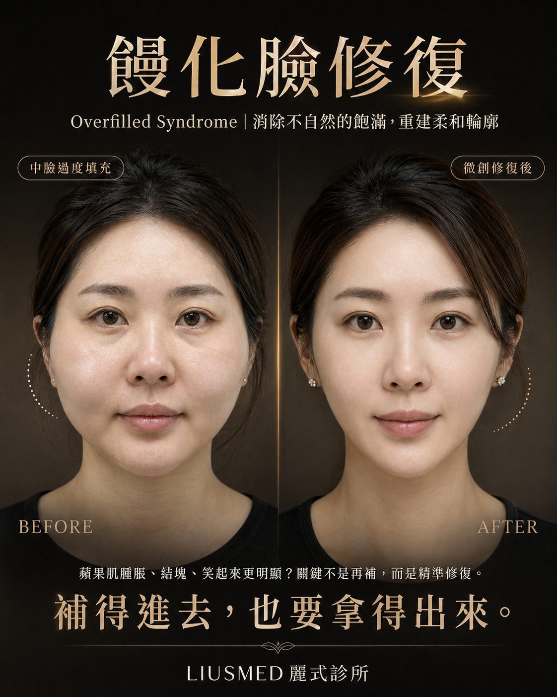 不敢大笑的「饅化」困擾：伊蓮絲結塊的微創修復