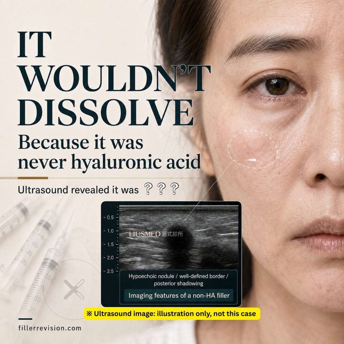 Filler Complication: When It's Not Hyaluronic Acid, More Hyaluronidase Won't Help