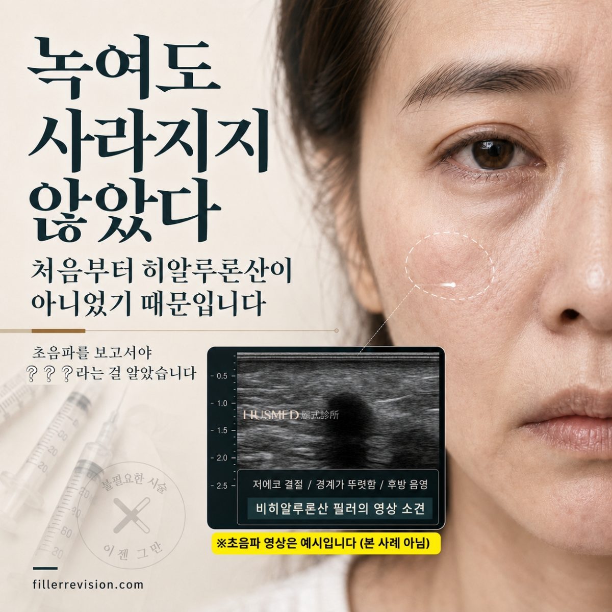필러 합병증: 얼굴 속 물질이 히알루론산이 아니라면, 히알루론산 분해효소를 아무리 맞아도 소용없다
