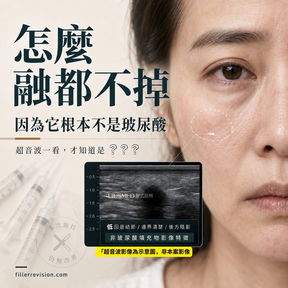 填充物併發症：當臉裡的不是玻尿酸，降解酶打再多也沒用