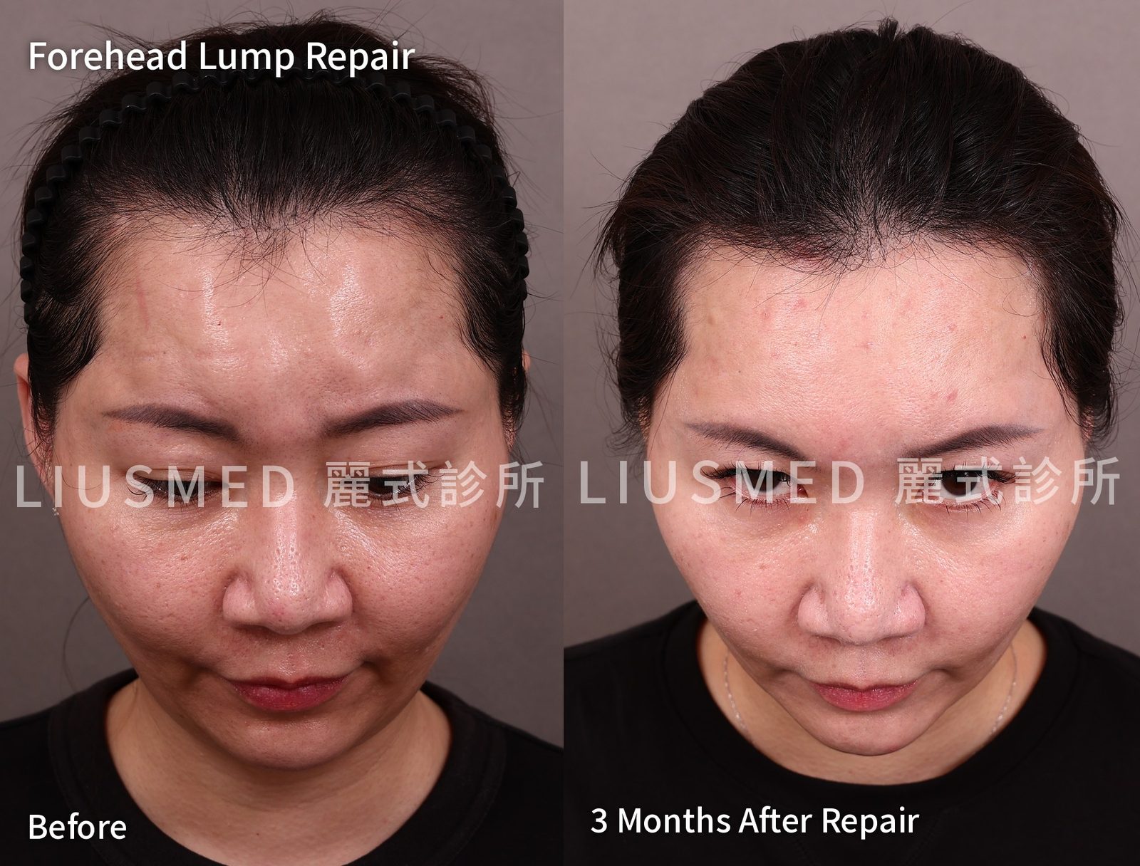Forehead Ellansé Lump Revision: Why I Only Take After Photos at Three Months