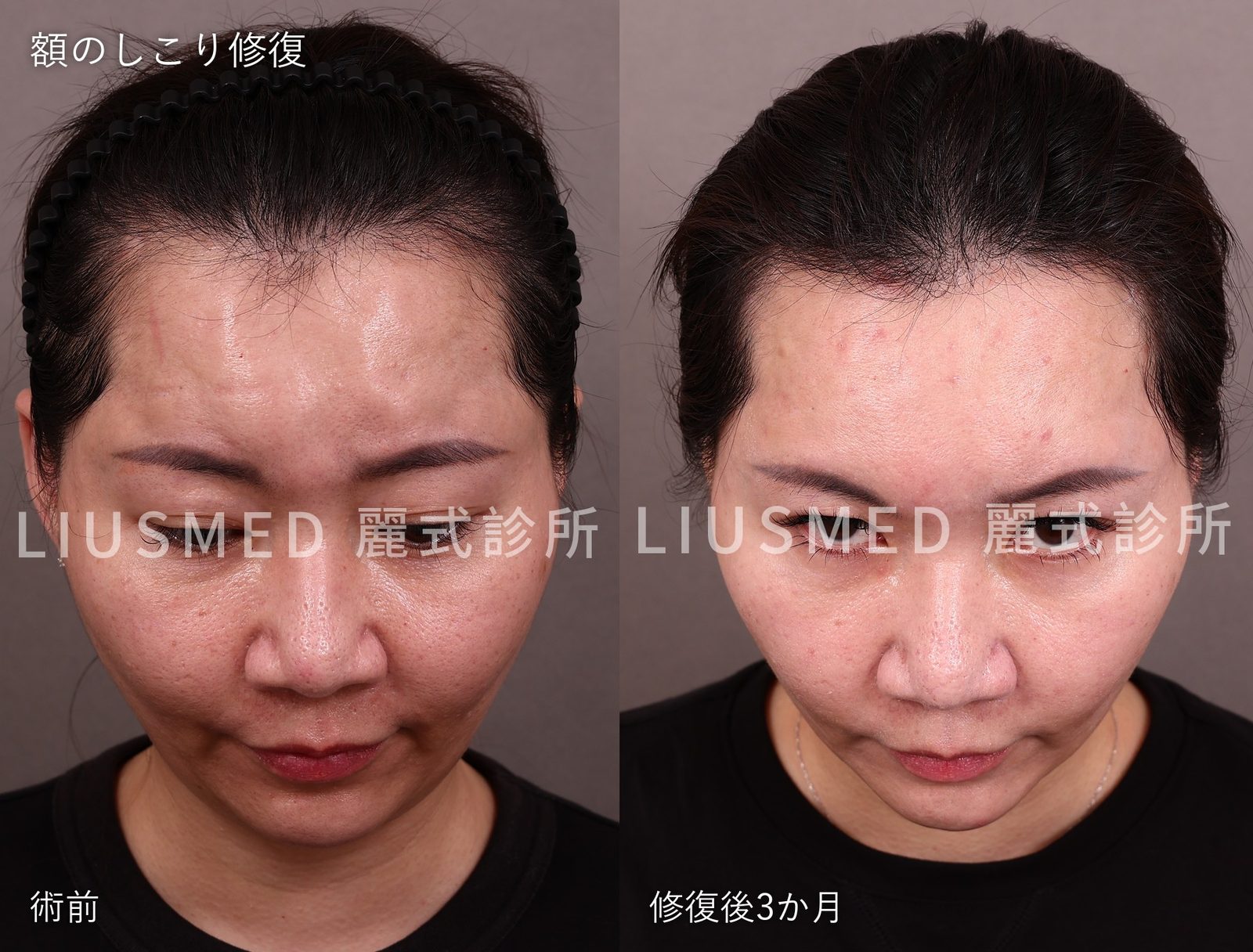 額のエランセしこり修復：術後写真を3か月後まで撮らない理由