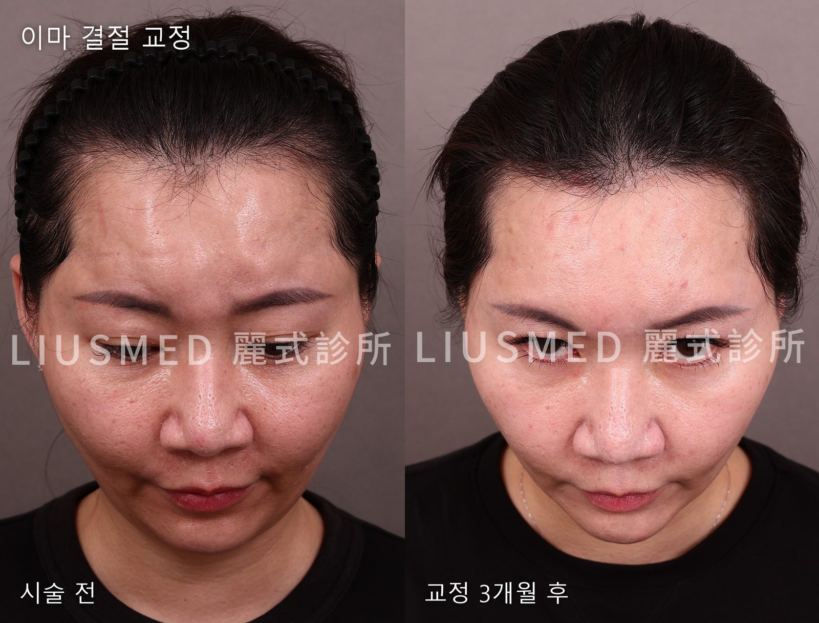 이마 엘란쎄 경결 수복: 시술 후 사진을 3개월 뒤에야 찍는 이유