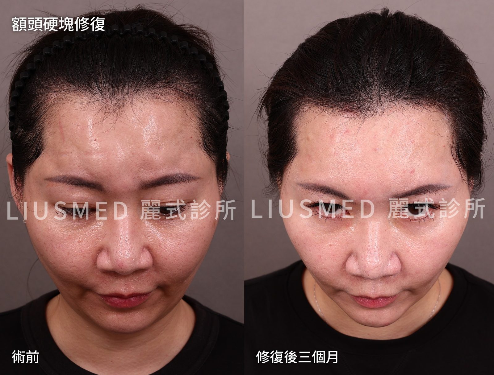 額頭洢蓮絲硬塊修復：為什麼術後照片要等三個月才拍？