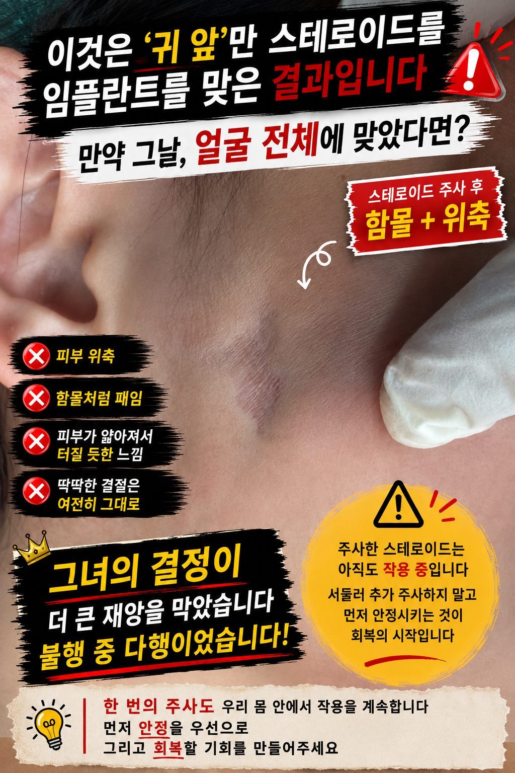 쥬베룩(Juvelook) 경결 처리: 스테로이드의 위험과 환자의 현명한 결정