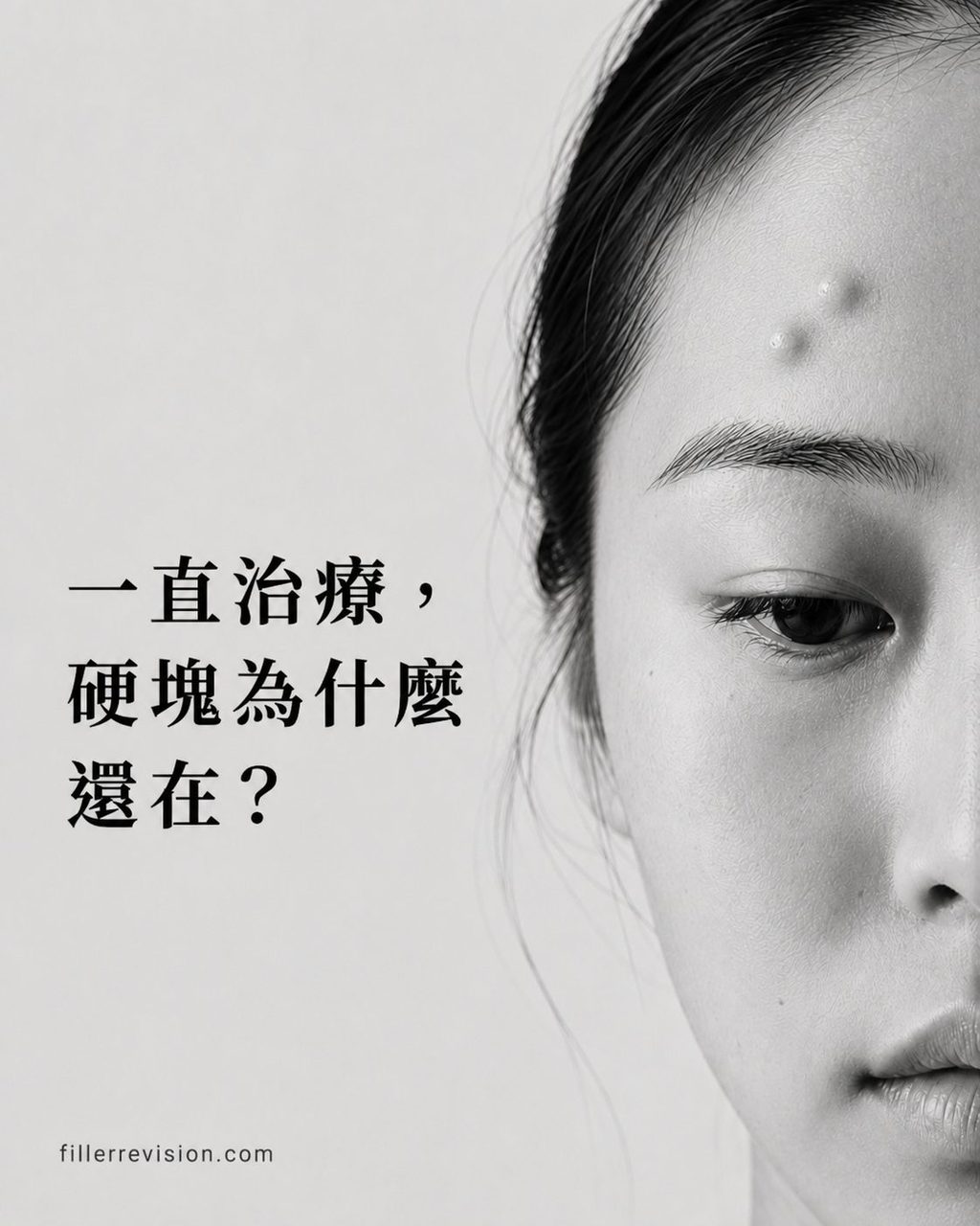 填充物硬塊反覆出現？它可能從未真正離開