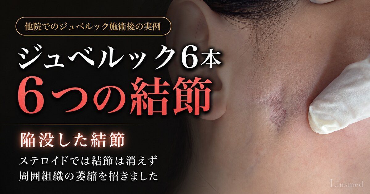 ジュベルック（Juvelook）注入後のしこりへの対応：ステロイドという両刃の剣