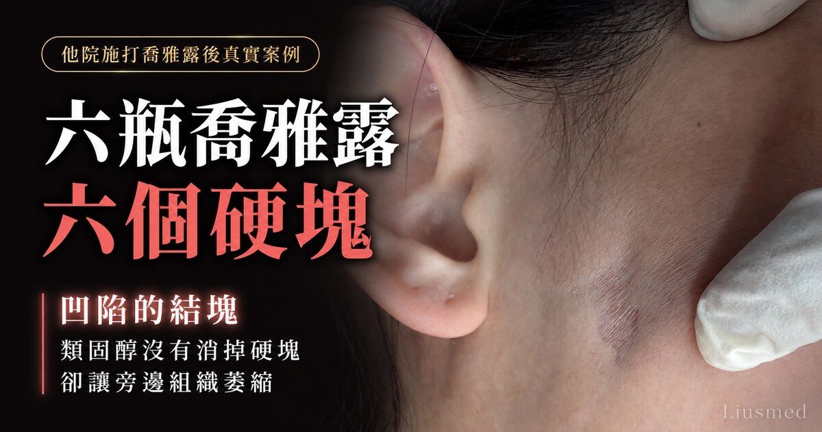 施打喬雅露後硬塊處理：類固醇的兩面刃
