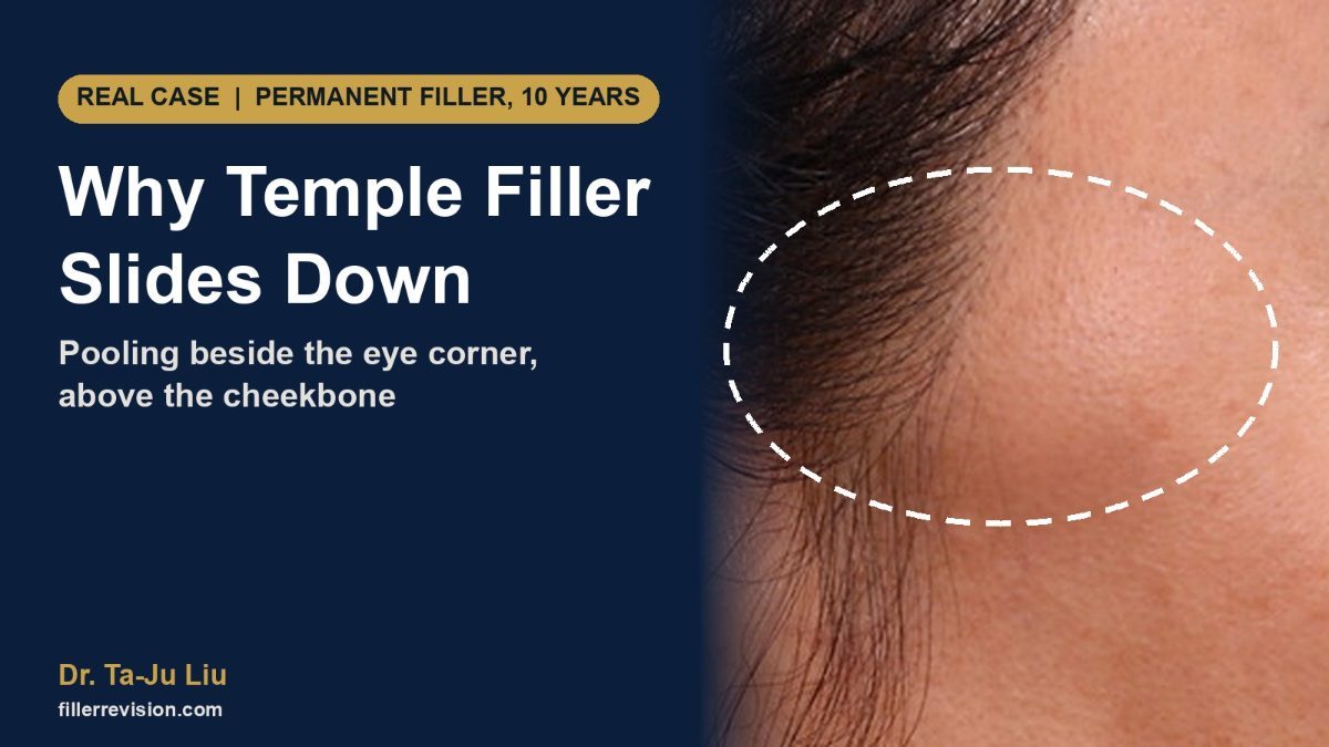 Temple Filler Migration: Shifting Permanent Fillers and Temporal Anatomy