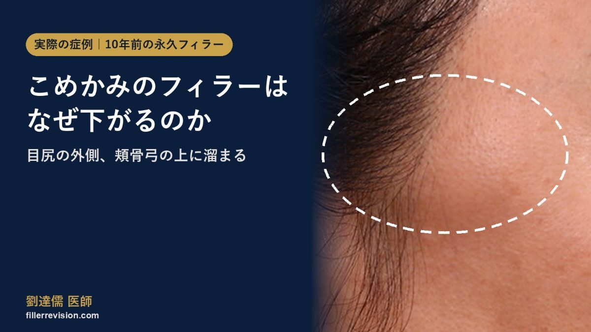 こめかみのフィラーのズレ：押すと動く永久フィラーと側頭部の解剖学的層