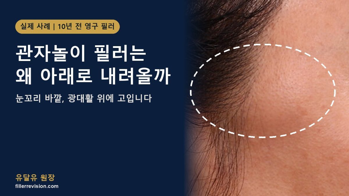 관자놀이 필러 이동: 누르면 이리저리 움직이는 영구 필러와 측두부 해부학적 층