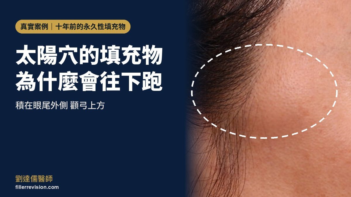 太陽穴填充物移位：按壓會跑來跑去的永久性填充物與顳部解剖層次
