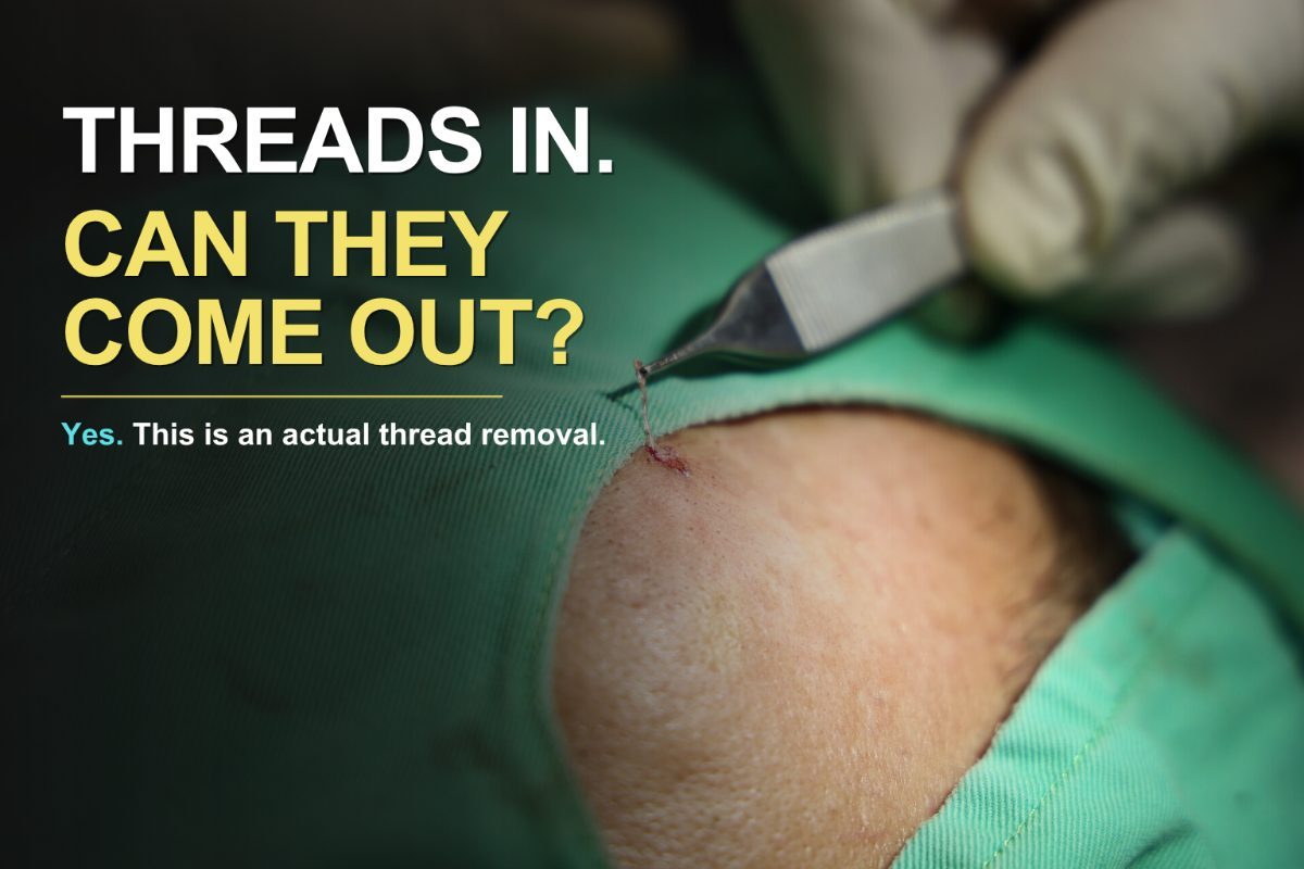 Did you know that thread lifts can actually be removed?