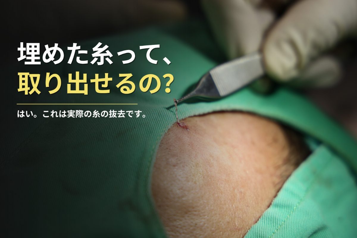 糸リフト（埋線）も除去できることをご存知ですか？