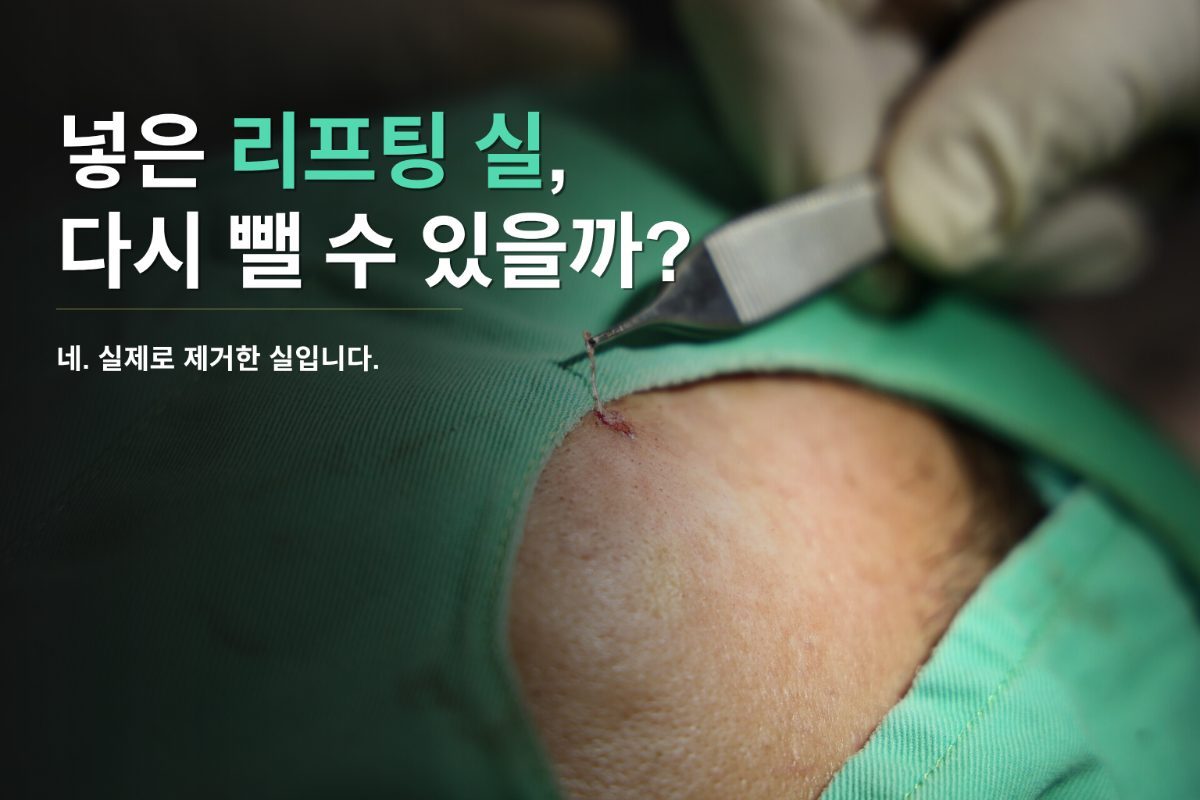 실 리프팅, 제거도 가능하다는 사실을 알고 계셨나요?