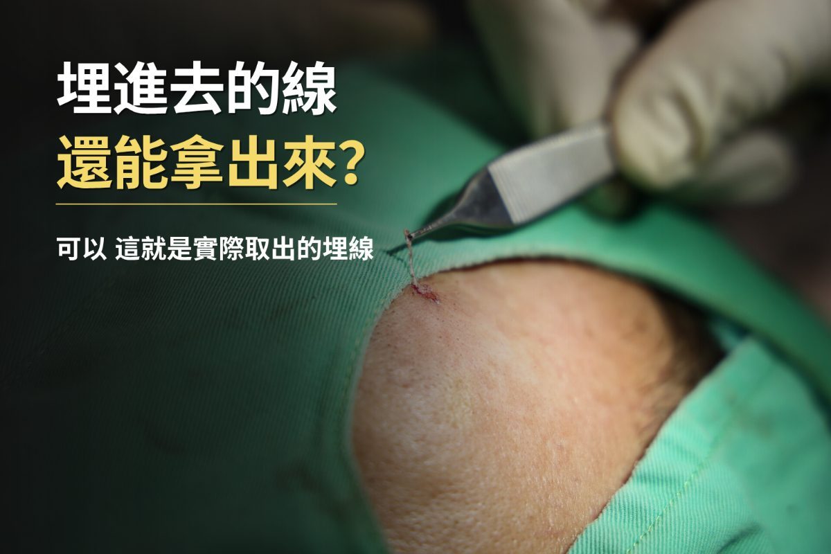 大家知道，埋線其實也可以取出來嗎？