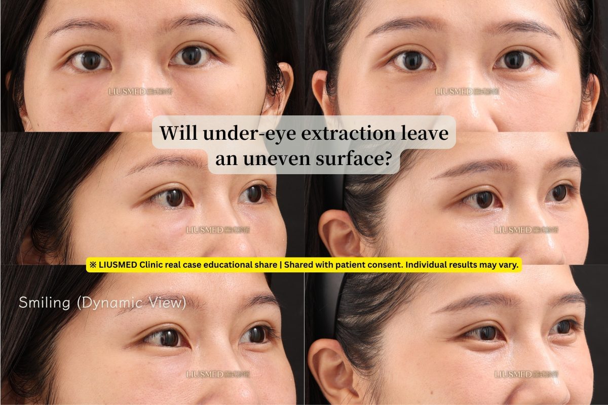 Will there be a depression after removing under-eye lumps?