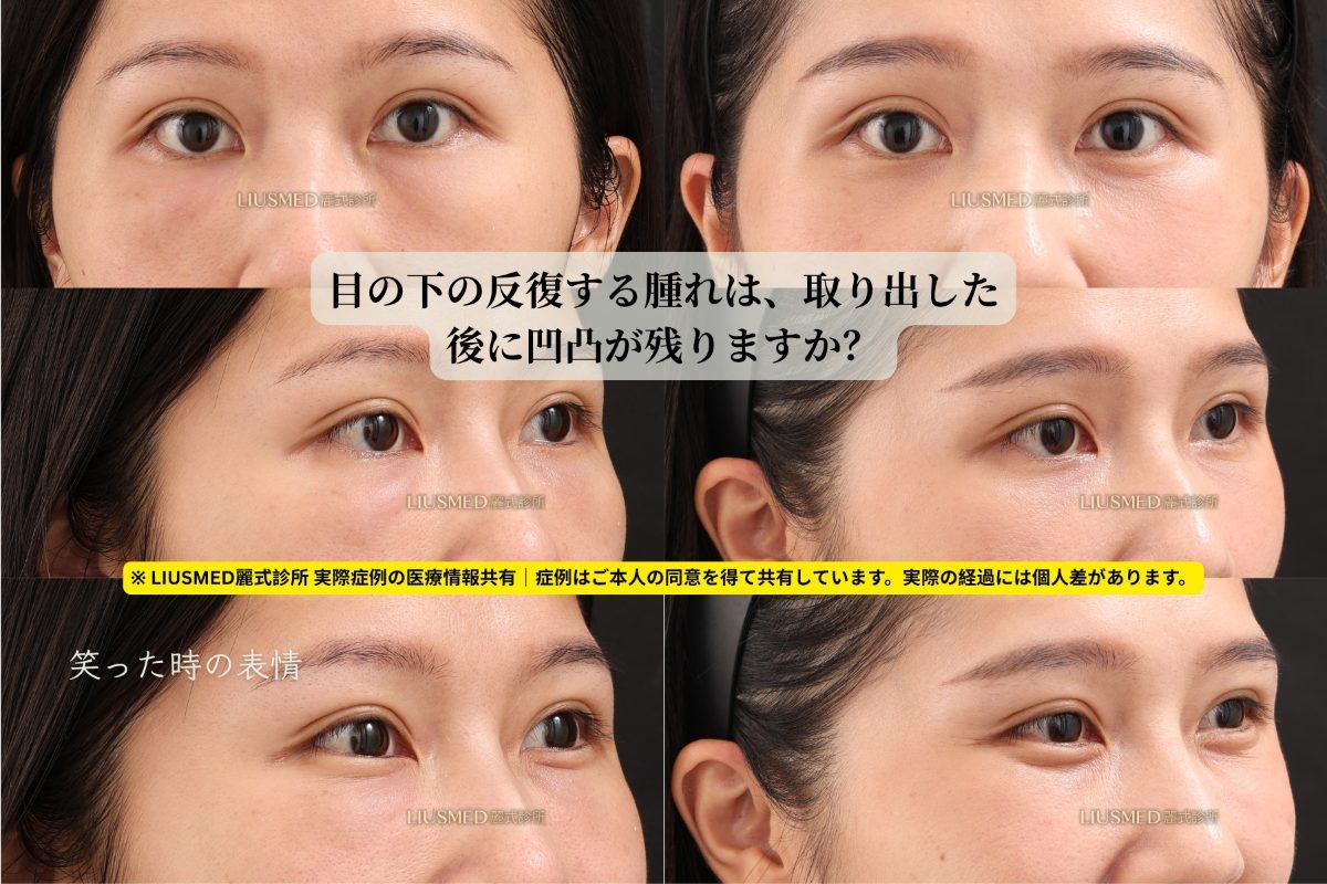 目の下のしこりを除去した後、凹みは生じますか？