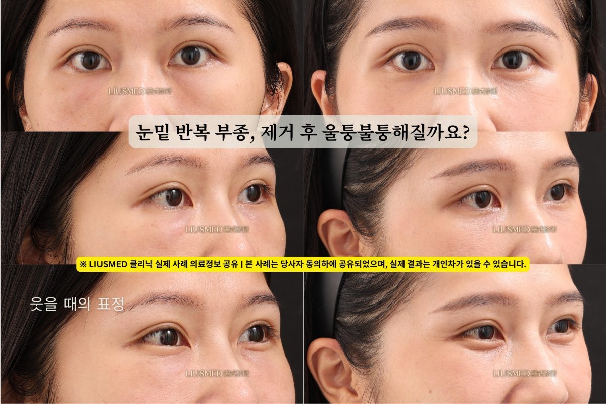 눈 밑 경결(Lump) 제거 후, 함몰이 생길까요?