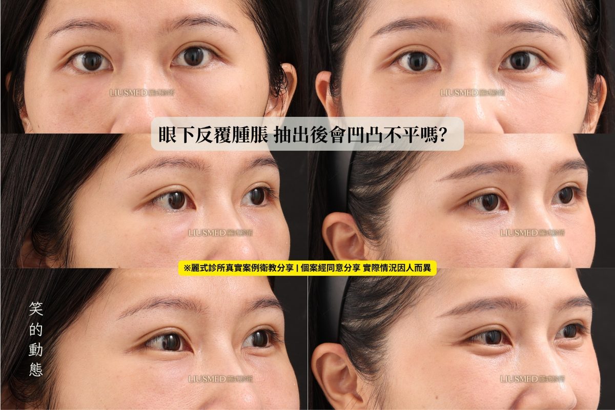 **眼下硬塊取出後，會不會凹陷？**