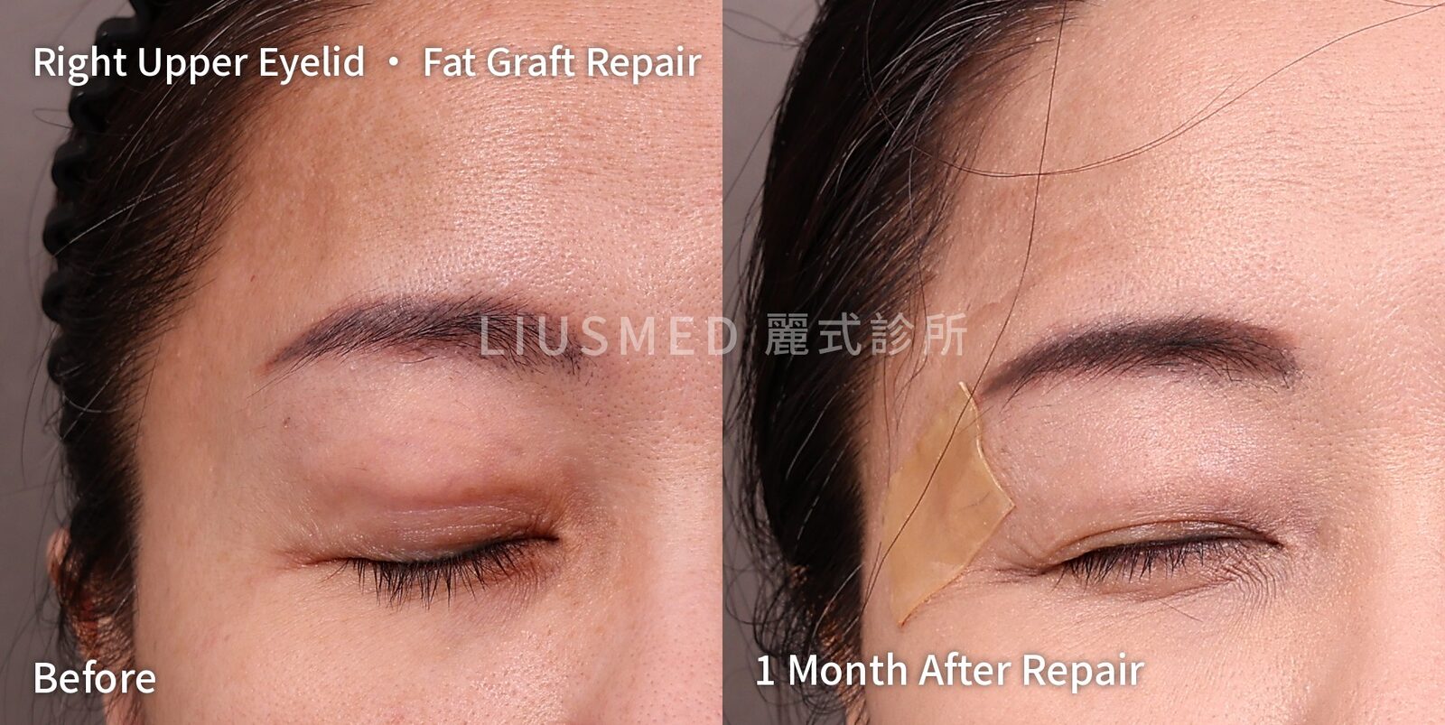 Fat Grafted Into Her Upper Eyelids Started to Bulge Three Months Later