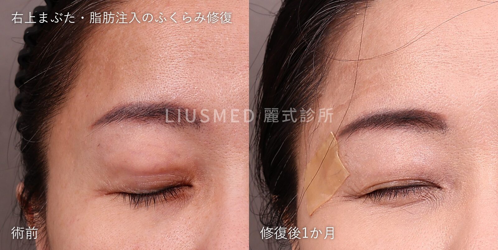 上まぶたに脂肪を注入して3か月、ふくらみ始めた