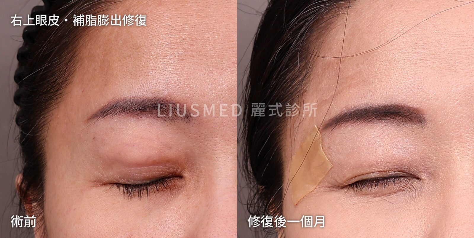 上眼皮補了脂肪，三個月後開始凸出來